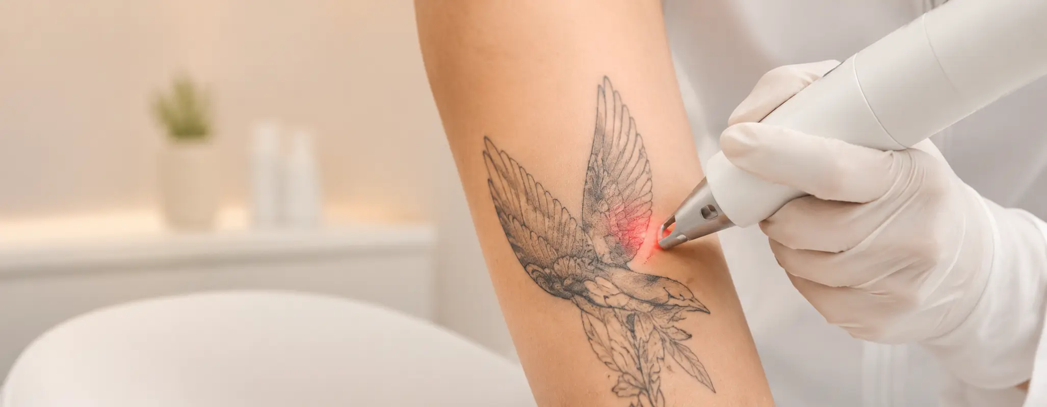 Remoção de tatuagens a laser na H2o Estética Leiria