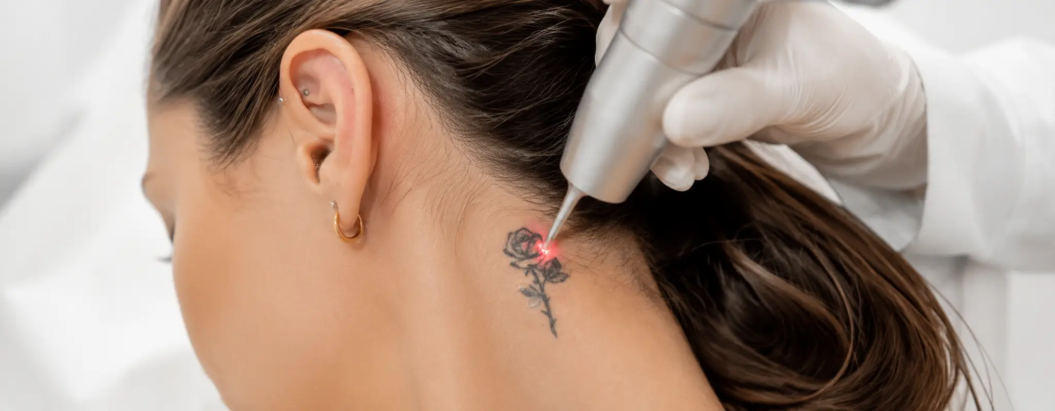Sessão de remoção de tatuagens a laser na H2o Estética Leiria