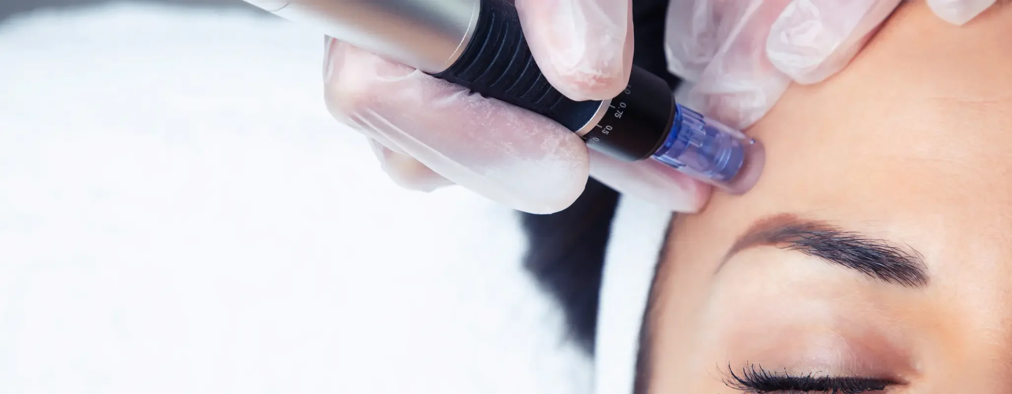 Terapia de microagulhamento para estimular a produção de colágeno e melhorar a aparência da pele. Tratamento especializado na H2o Estética Leiria